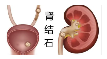 肾结石会有哪些症状