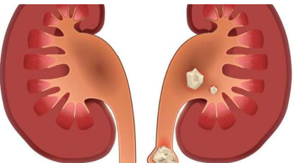 肾结石怎么排出来最快方法