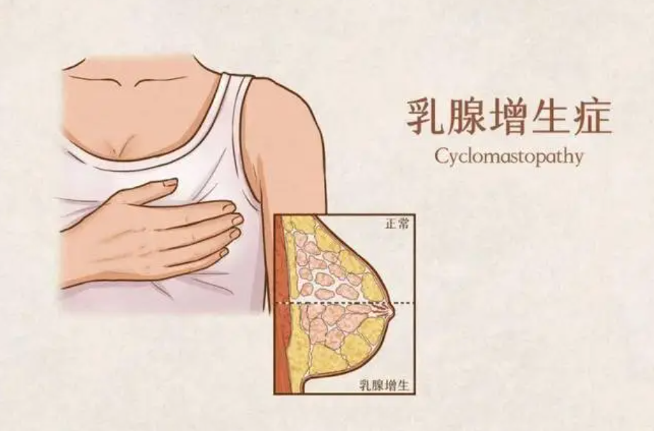 乳腺增生的症状有哪些症状